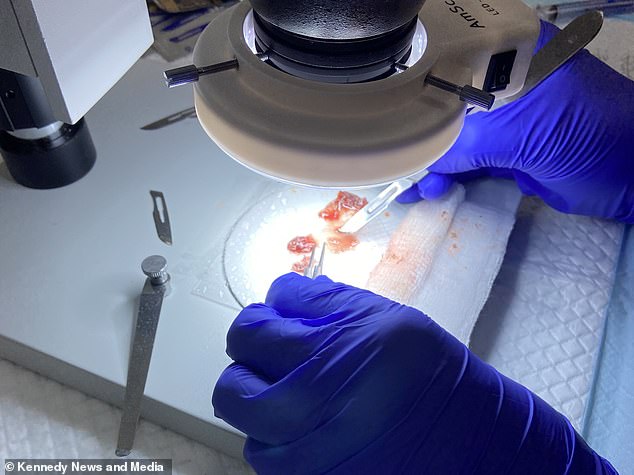 Surgeons examine some of Mr Brown's hair follicles under a microscope before implanting them in his face