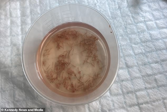 A cup of harvested hair follicles from the back of Lee Brown's head - which were implanted directly into his face over the course of 12 hours