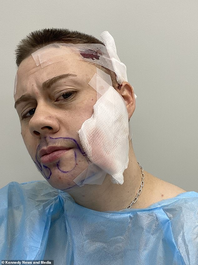 Mr. Brown during a break from surgery.  He says he 'looked and felt like a truck had run over my face' – but in the long run he was happy with the results