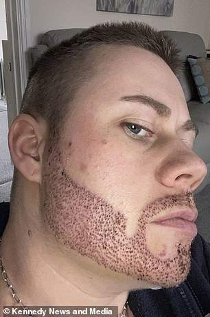 Lee Brown, 10 days after his beard transplant