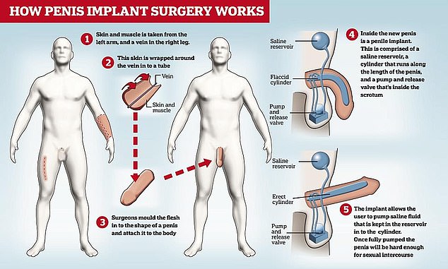 A diagram shows how Andrew's bionic penis is extracted from the skin of his forearm and a vein in his leg.  It is then rolled into the shape of a manhood and tied.  Inside the penis is a penile implant that pumps saline into the cylinder, causing the penis to become erect for sexual intercourse