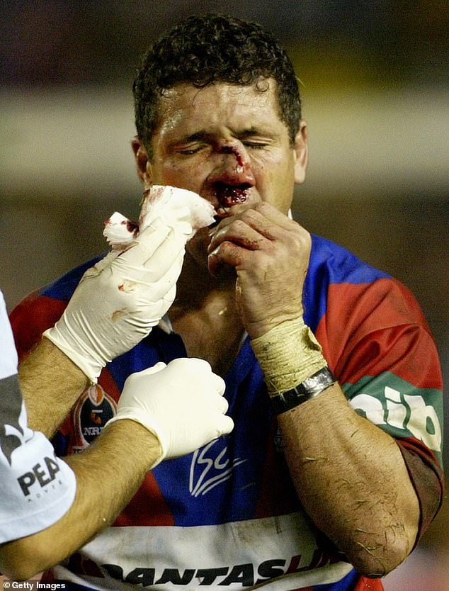 O'Davis was known for his aggressive approach to the game and suffered a particularly serious injury where he shattered his nose and broke the roof of his mouth after an on-field collision in 2003