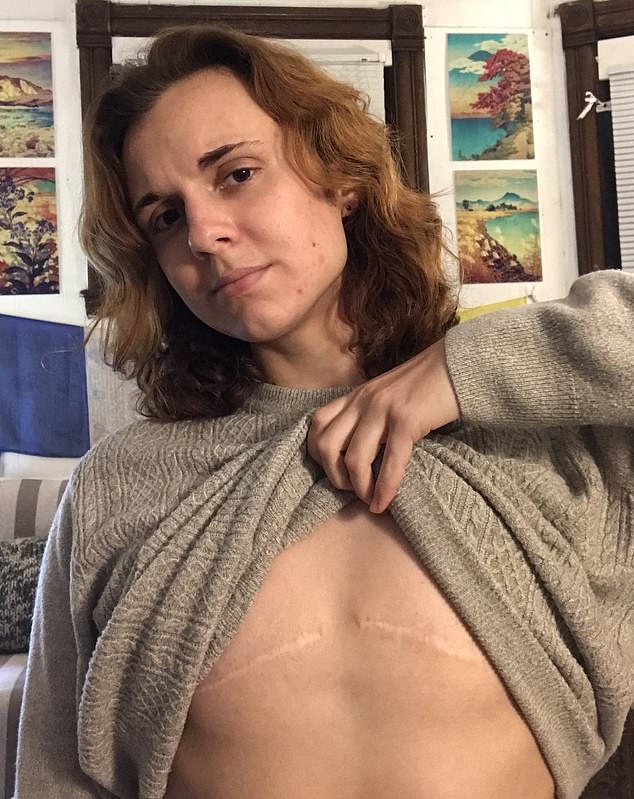 Luka shows the scars on her chest after her irreversible double mastectomy