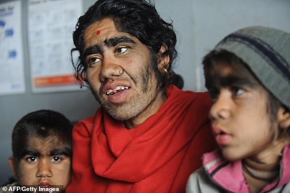 A Nepalese mother and her children with hypertrichosis, also called 'werewolf syndrome' (archive photo)