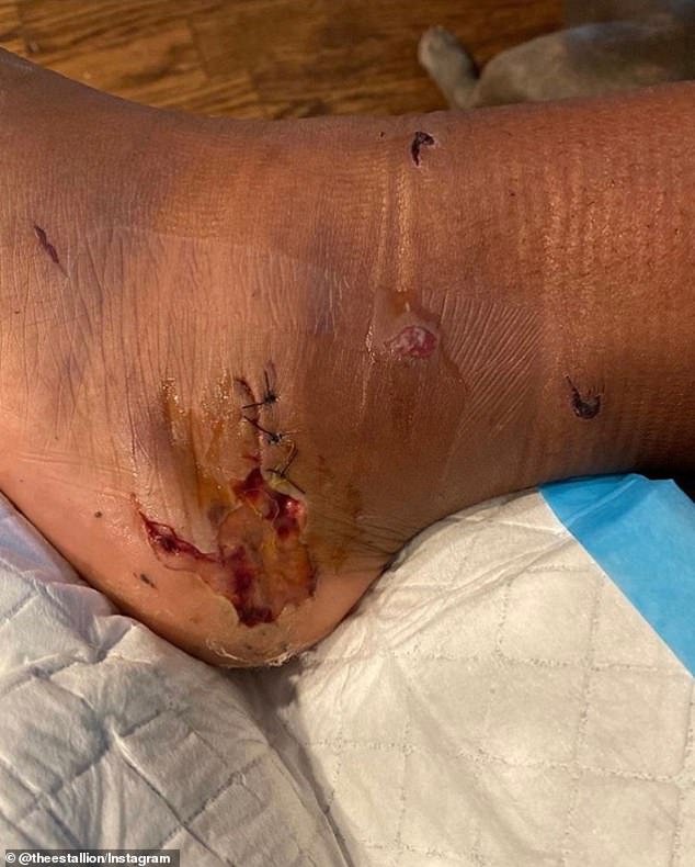 Megan posted a photo of her foot injury on Instagram after the shooting