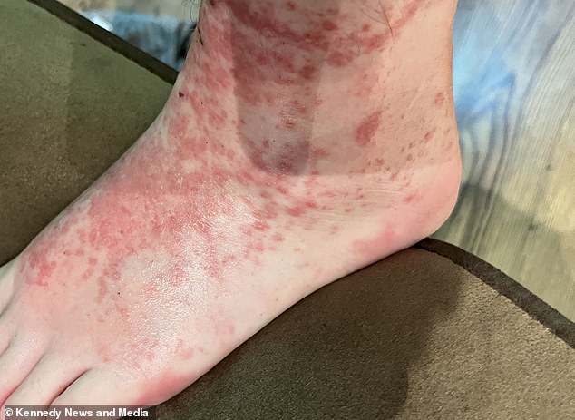 After attending a family birthday party on September 4, Becca wore them for the first time and developed a severe rash on her feet and ankles that she initially thought might be eczema.