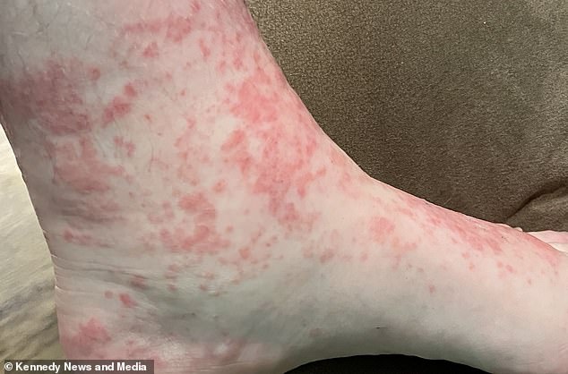 The doctor blamed the trainers on scabies or an allergic reaction and quickly gave her medication to treat it