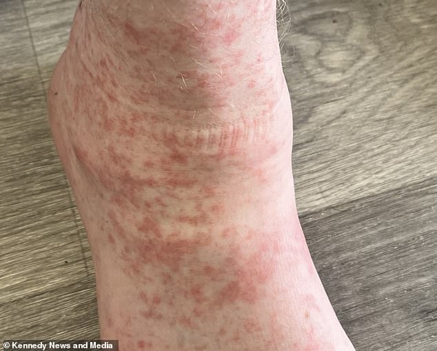 The spreading rash prompted her to have it examined by doctors - who thought it was likely an allergic reaction or scabies, a parasitic infestation caused by tiny mites that burrow into the skin and lay eggs.