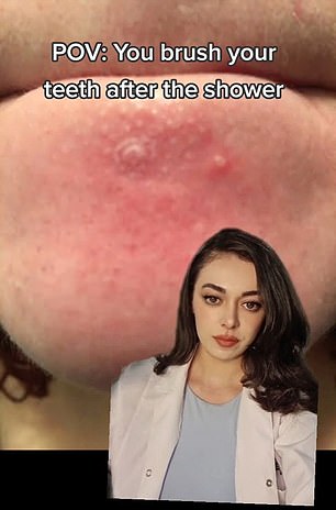 The photos above show pimples that dermatologists say can appear on your chin when you brush your teeth after showering