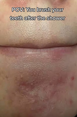 Zits that can be caused by saliva on the chin