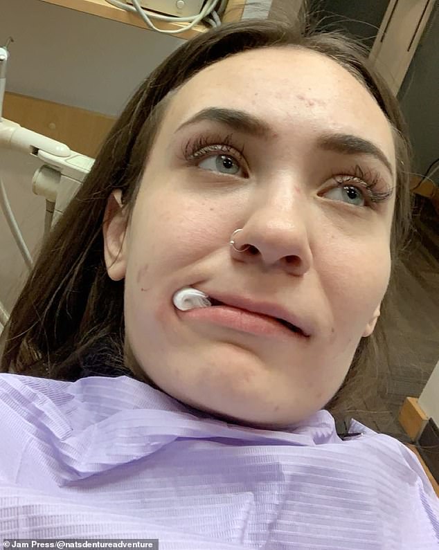 Natalie openly shared her teeth journey online and gained 19,500 followers on TikTok.  Thanks to her GoFundMe, she was able to raise $9,909 for a set of permanent teeth