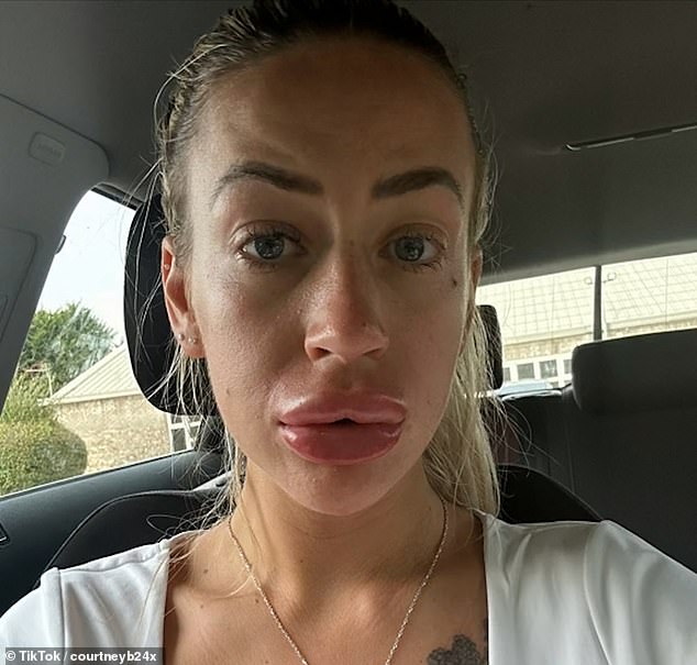 Her lips blossomed immediately after the procedure.  She is pictured here in a car after an appointment.  She claimed her allergy test immediately came back red, but her doctor told her she was not allergic