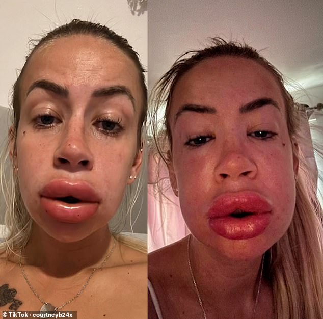 The 27-year-old's lips continued to get worse overnight, despite the doctor telling her they were going down.  She said her lips felt like they were going to 'pop'