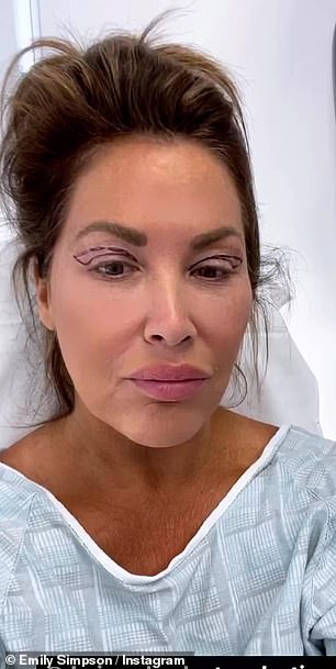 Before and after: Simpson shared a before and after look at her upper eyelid surgery on her Instagram Stories