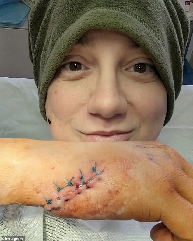 She was hospitalized for 16 days after being hit in the head and hand by an artillery shell in Ukraine's Donbass region on February 23.  She immediately returned to the front line