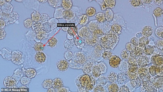 Cells from the lungs of a patient with silicosis.  Notice that the speck of silica dust shines brightly