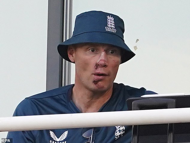 Flintoff's injuries were still evident nine months after the crash, with him suffering broken ribs and facial bones