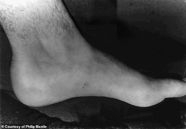 On Parker, 'similar punctures were noted on the inside of his foot as indicated in the photos'