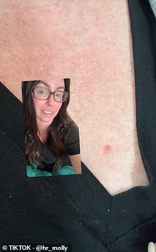 Molly, who goes by HR_Molly on TikTok, shared a series of videos this summer explaining how she thought pimples on her skin were just acne or bug bites.  It turned out to be skin cancer