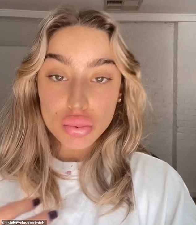Social media is full of warnings about botched fillers and Botox – with TikTok user Claudia Simich revealing earlier this year how her lips swelled after getting injections