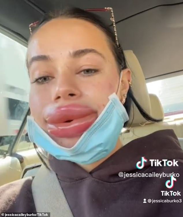 Meanwhile, Los Angeles native Jessica Burko was left in tears after a filler appointment left her lips swollen and enlarged