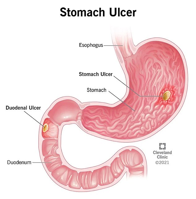 The above image shows the stomach and the beginning of the small intestine.  It also highlights the ulcers that cause stomach ulcers