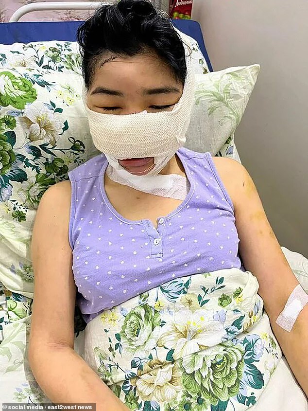 Estebesov launched the horrific hours-long attack, cutting off Asel's nose and ears as she screamed in pain (pictured after the attack) - all while their child hid under the covers.