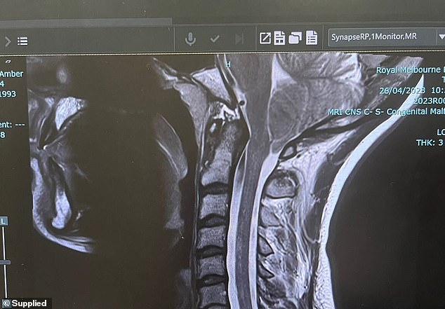 The malfunction causes the brain to press against the spinal cord, causing major problems