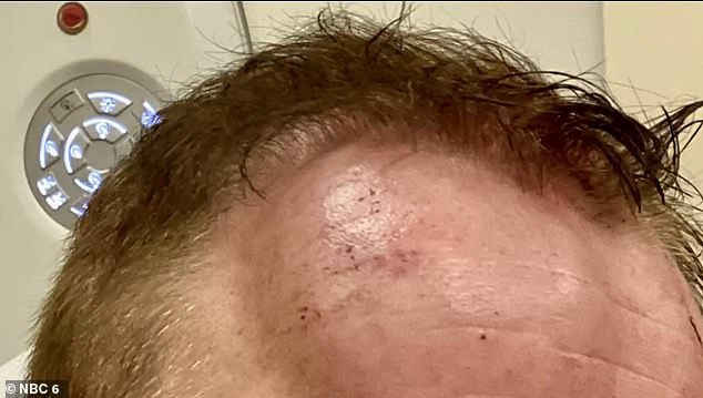 Cohen was also seen with a huge bump on his head after his fall