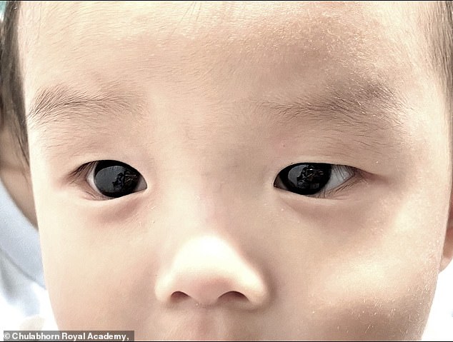 The six-month-old boy's eyes are naturally dark brown.  He was diagnosed with Covid and treated with favipiravir, making him the youngest patient to receive the drug