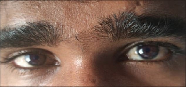 A 2021 study reports the case of a 20-year-old man in India who experienced the exact same eye color change