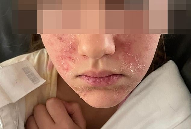 An 11-year-old girl suffered burns and peeling of her skin (above) after using three Kmart skin products.