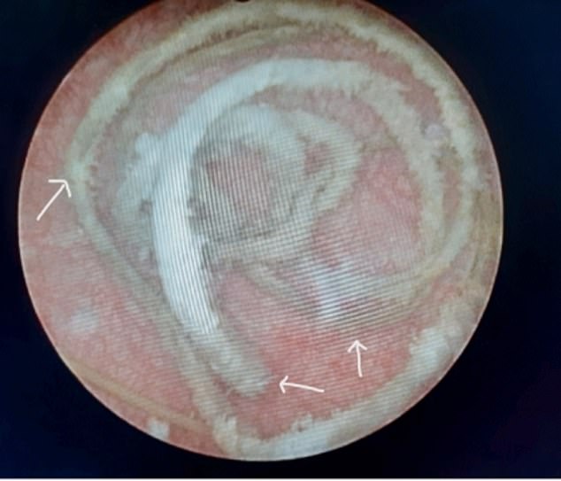 The photo shows the long, coiled wire found in the patient's bladder.  It had become covered with deposits of calcium salts