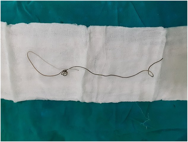 The photo above shows the foreign object, an eight-inch-long wire, that was removed from the patient's body