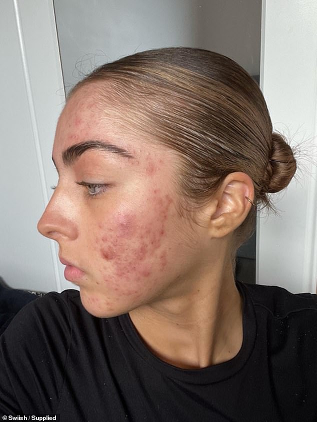 Ella Nelson, 16, from East Gosford on the New South Wales central coast, suffered from cystic acne for eight months and suffered a major blow to her self-esteem