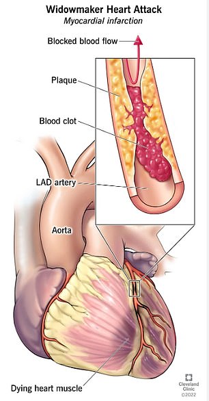 The above image shows what happens in a widow's heart attack, caused by a blockage of the left main coronary artery (LMCA)