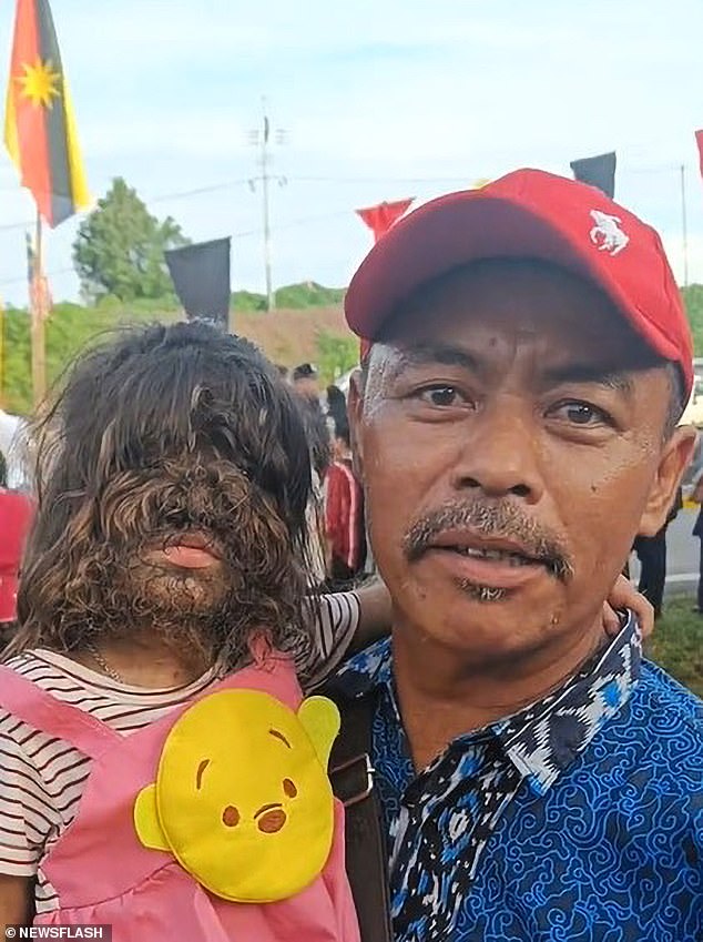 Two-year-old Missclyen, pictured with her father Roland Jimbai, has a condition that causes excessive hair growth