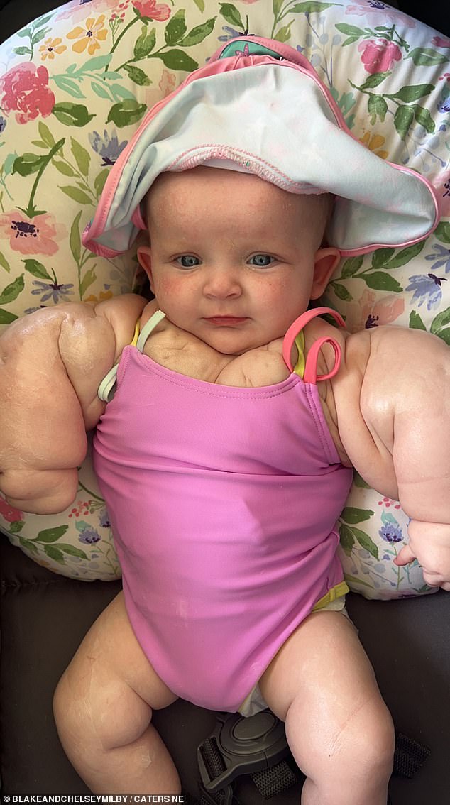 Armani Milby, from Campbellsville, Kentucky, was born with a condition that left her with swollen arms and legs.  Her mother Chelsey has nicknamed her 'mini Hulk'