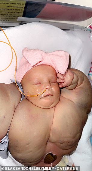 The baby has a condition called lymphangioma, which has caused her arms and chest to become swollen due to a buildup of fluid