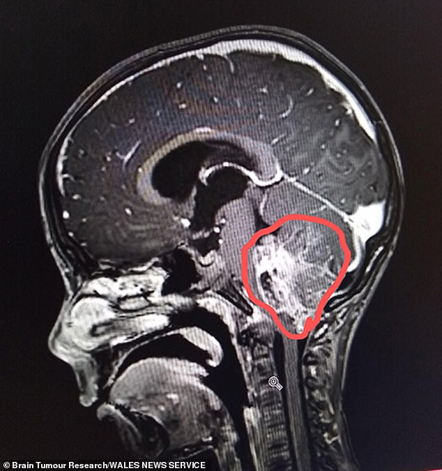 A CT scan showed she had a grade three anaplastic ependymoma