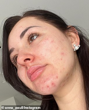 Before: An Australian TikTok star has shocked her fans after sharing an incredible transformation of her bad skin