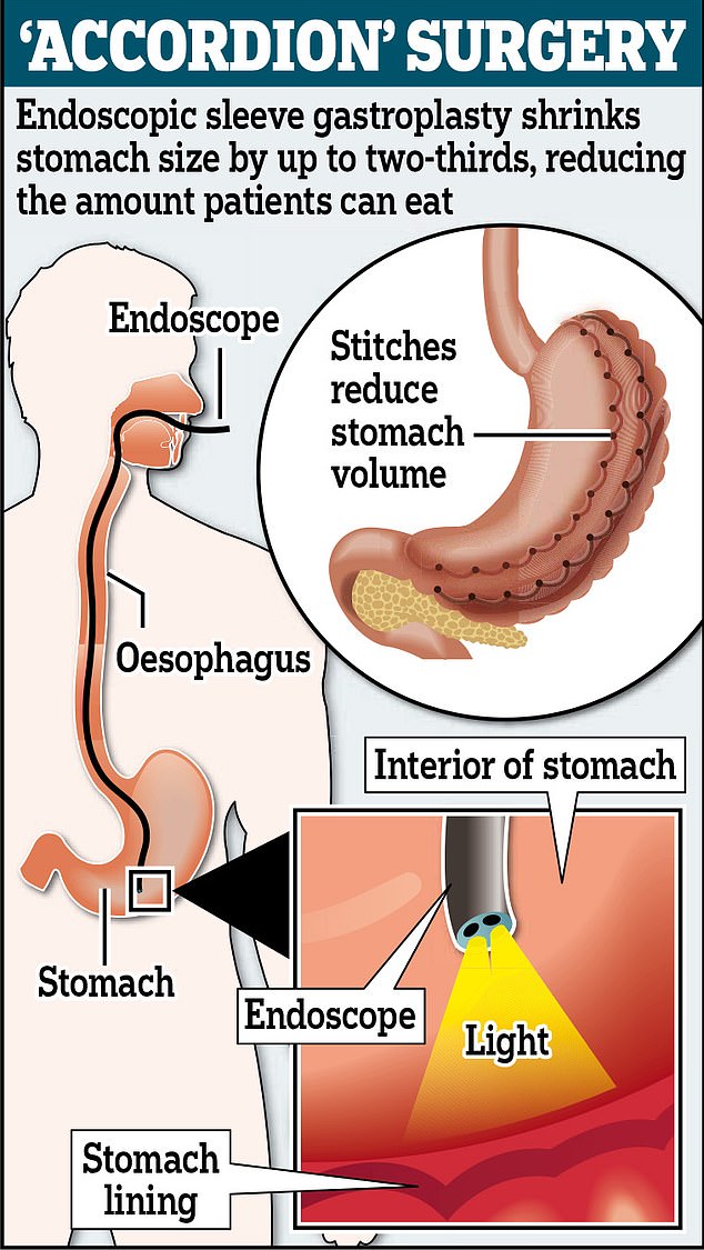 Weight loss operation you can have in 90 minutes which slashes