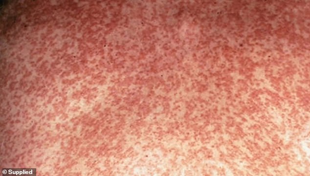 Measles causes several symptoms, including a red rash (pictured) all over the body, fever, sore eyes and coughing