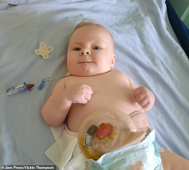 After doctors confirmed he had an imperforate anus - meaning it is narrow or non-existent - Charlie was transferred to the neonatal intensive care unit (NICU) and the contents of his stomach were removed.  The next day he was taken to Brighton Hospital where doctors created a stoma.  A stoma is an opening in the abdomen that can be connected to either the digestive or urinary system.  To prevent bowel movements, a bag may be placed over the stoma.  In the picture Charlie with his ostomy bag