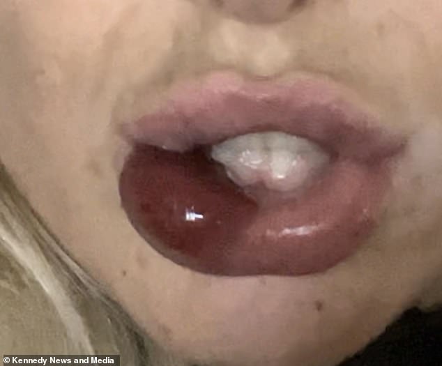 The mum-of-one said she paid £75 for 1ml of lip filler in January but claims she only got 0.5ml as she begged the specialist to stop