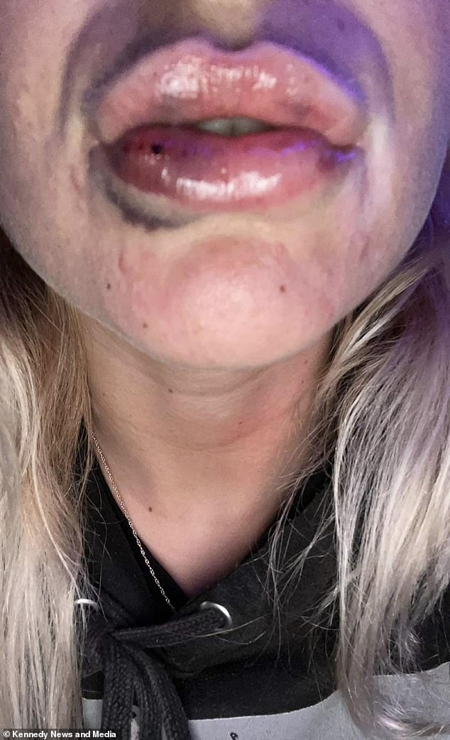 The pharmacy worker said that the condition of her lips caused concern among her work colleagues, who believed that she was a victim of domestic violence.