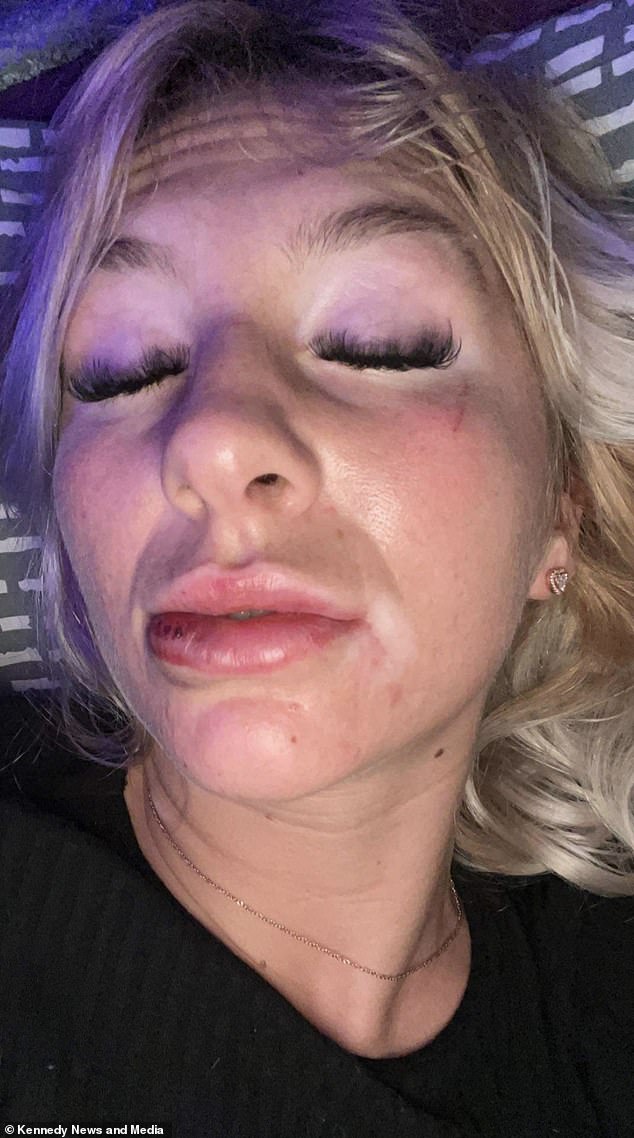 She accused the specialist of bursting a blood vessel in her lower lip during the procedure