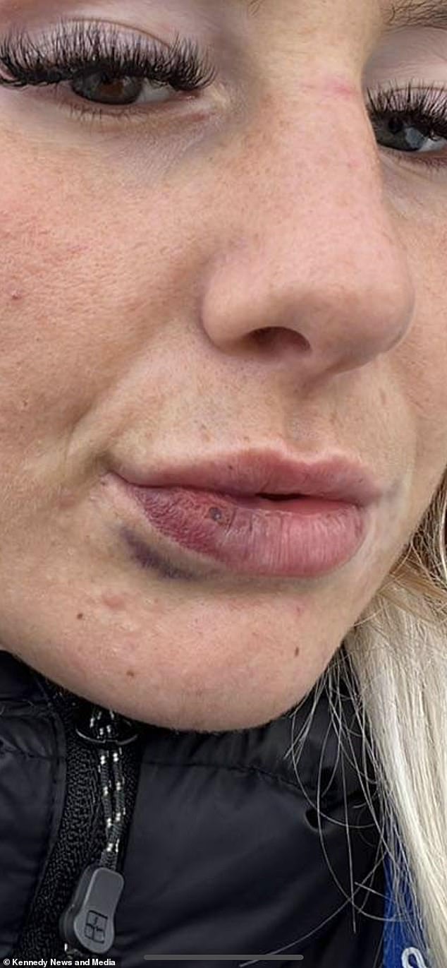 Natalie described the lump on her lip at the time as 'a bowling ball' and was forced to spend a month hiding it behind a face mask.