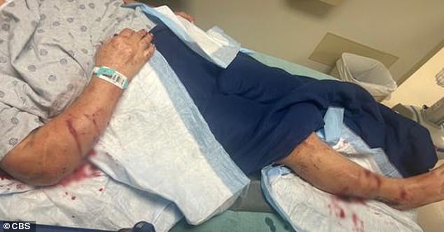 The grandmother needed more than 100 stitches for 'very, very deep and painful' bites