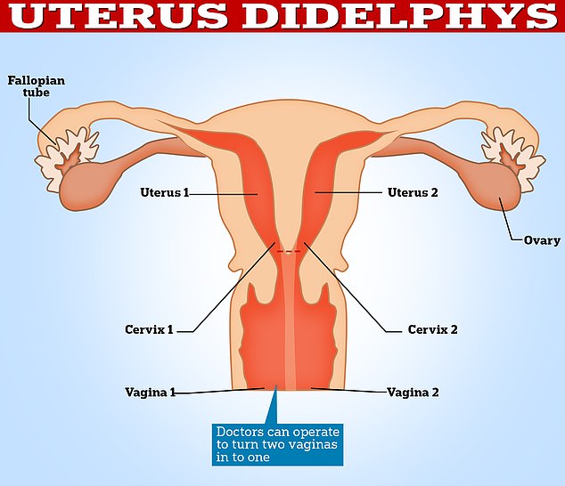 A double uterus occurs when a developing uterus – which starts out as two separate ducts – fails to join together.  Doctors do not yet know why the condition occurs.  But it is believed that only one in 3,000 women are affected.  It can cause infertility in some patients because it increases the risk of miscarriage because the uterus is smaller and can restrict the growth of a fetus.  Surgery to join a double uterus together is possible, but is not often recommended by doctors unless patients experience severe symptoms